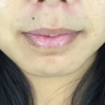 Chin Fillers Before & After Patient #728