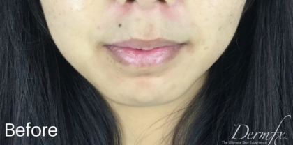 Chin Fillers Before & After Patient #728