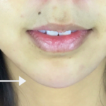 Chin Fillers Before & After Patient #728