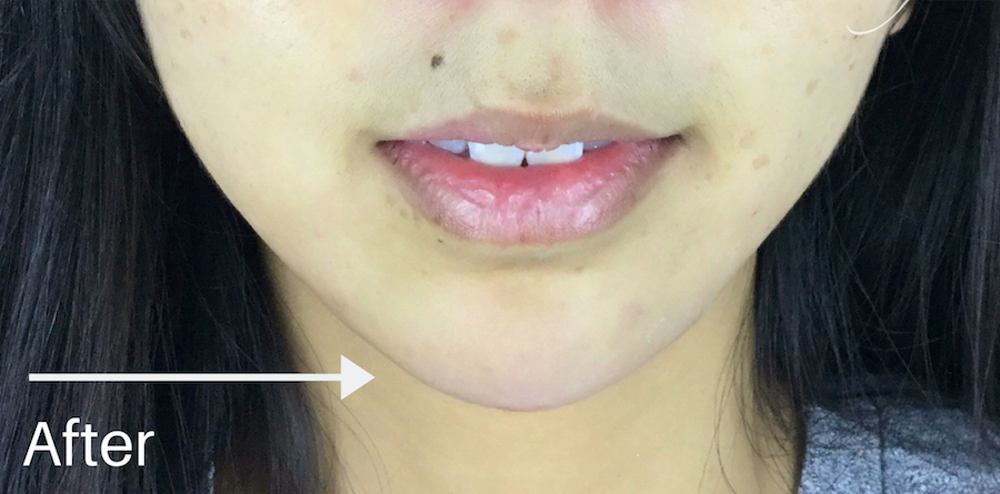 Chin Fillers Before & After Patient #728