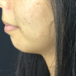 Chin Fillers Before & After Patient #728