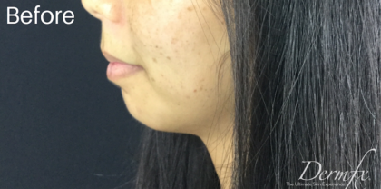 Chin Fillers Before & After Patient #728