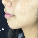 Chin Fillers Before & After Patient #728