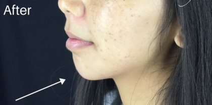 Chin Fillers Before & After Patient #728