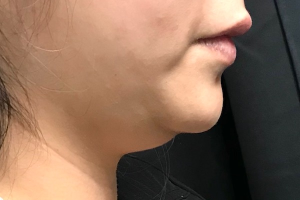 CoolSculpting Before & After Patient #662