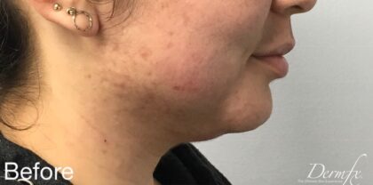 Kybella Before & After Patient #733