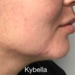 Kybella Before & After Patient #733