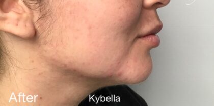 Kybella Before & After Patient #733