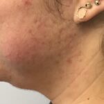 Kybella Before & After Patient #733