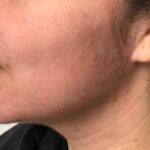 Kybella Before & After Patient #733