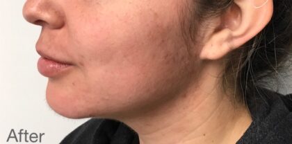 Kybella Before & After Patient #733