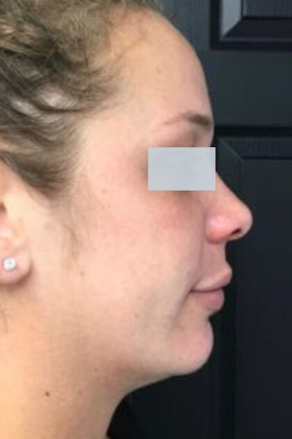 Jawline Fillers Before & After Patient #738