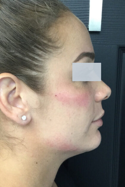 Jawline Fillers Before & After Patient #738