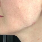 Jawline Fillers Before & After Patient #741