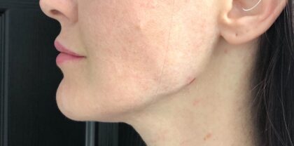 Jawline Fillers Before & After Patient #741