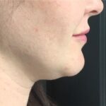 Jawline Fillers Before & After Patient #741