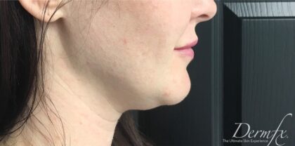 Jawline Fillers Before & After Patient #741