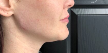 Jawline Fillers Before & After Patient #741