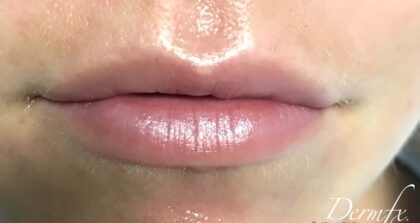 Lip Injections Before & After Patient #749