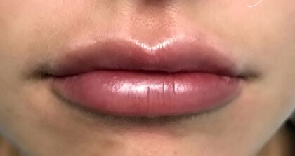 Lip Injections Before & After Patient #749