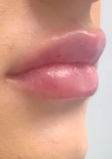 Lip Injections Before & After Patient #752