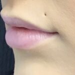 Lip Injections Before & After Patient #752