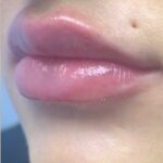Lip Injections Before & After Patient #752