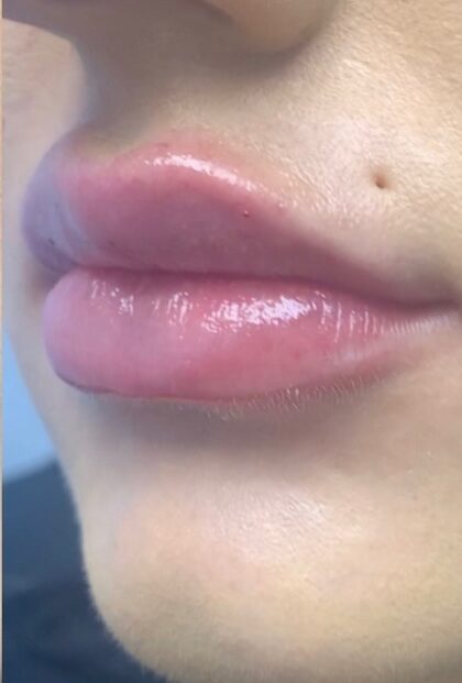 Lip Injections Before & After Patient #752