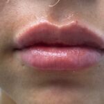 Lip Injections Before & After Patient #757
