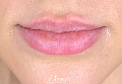 Lip Injections Before & After Patient #760