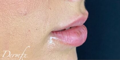 Lip Injections Before & After Patient #760