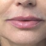 Lip Injections Before & After Patient #768