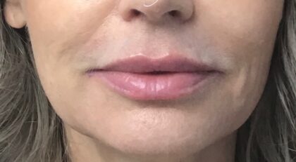 Lip Injections Before & After Patient #768