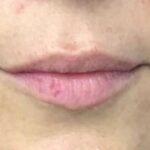 Lip Injections Before & After Patient #773