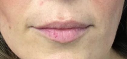 Lip Injections Before & After Patient #773