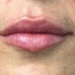 Lip Injections Before & After Patient #773