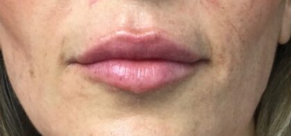 Lip Injections Before & After Patient #773