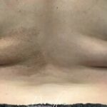 CoolSculpting Before & After Patient #665