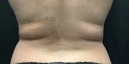 CoolSculpting Before & After Patient #665