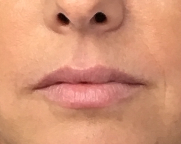 Lip Injections Before & After Patient #779