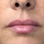 Lip Injections Before & After Patient #779