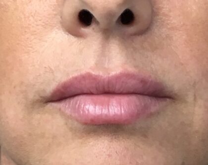 Lip Injections Before & After Patient #779