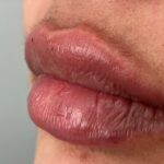Lip Injections Before & After Patient #784