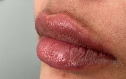 Lip Injections Before & After Patient #784