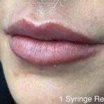Lip Injections Before & After Patient #792