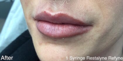 Lip Injections Before & After Patient #792