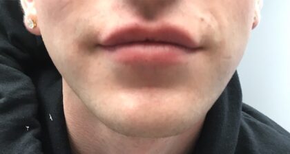 Lip Injections Before & After Patient #795