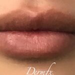 Lip Injections Before & After Patient #798