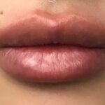 Lip Injections Before & After Patient #798
