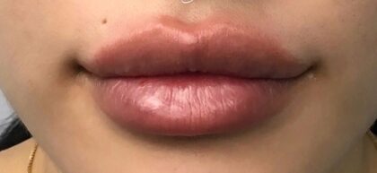 Lip Injections Before & After Patient #798